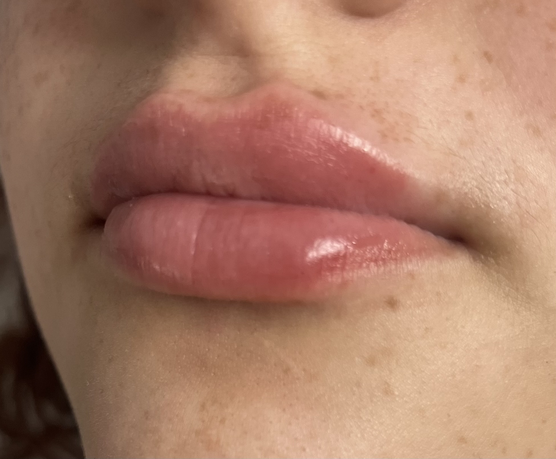 Lip filler results