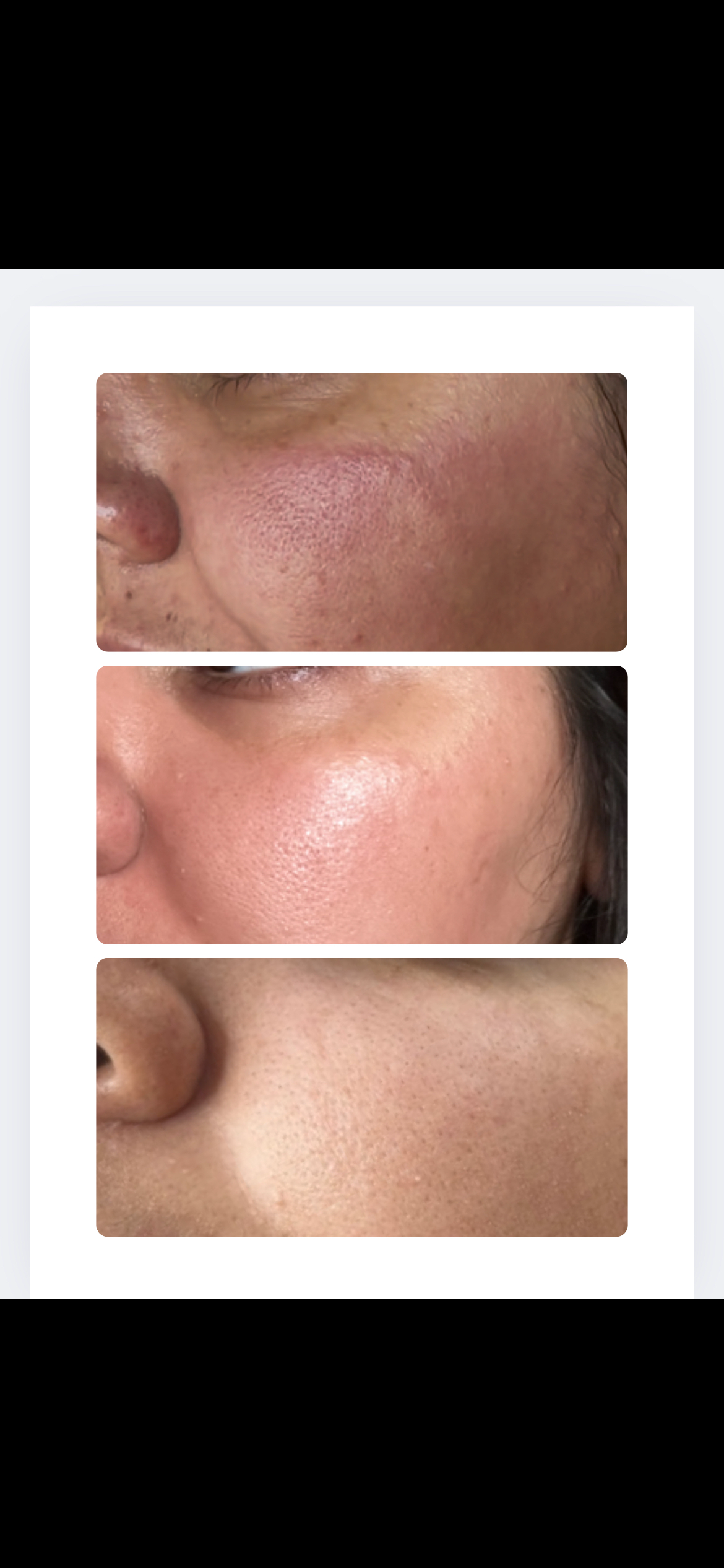 Microneedling before and after